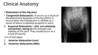 Clinical Anatomy
• Dislocation of the Hip Joint
• Congenital Dislocation:- It occurs as a result of
developmental dysplasia of the hip (DDH). It
occurs when the Acetabulum is shallow as a
result of failure to develop properly in utero
1. Acquired Dislocation :- this are relatively
uncommon, owing to the strength and
stability of the joint. They usually occur as a
result of trauma.
It is of two types
2. Anterior dislocation (rare)
3. Posterior dislocation.(90%)
 