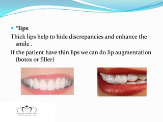  *lips
Thick lips help to hide discrepancies and enhance the
   smile .
If the patient have thin lips we can do lip augmentation
   (botox or filler)
 