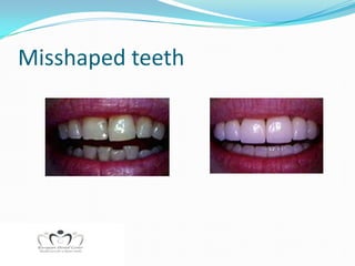 Misshaped teeth
 