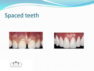 Spaced teeth
 