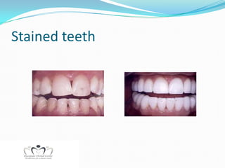 Stained teeth
 