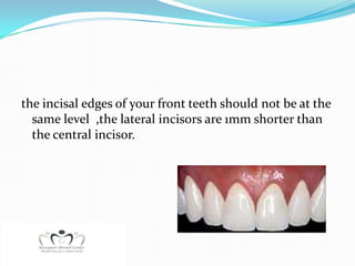the incisal edges of your front teeth should not be at the
  same level ,the lateral incisors are 1mm shorter than
  the central incisor.
 