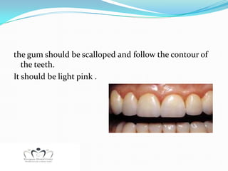 the gum should be scalloped and follow the contour of
   the teeth.
It should be light pink .
 