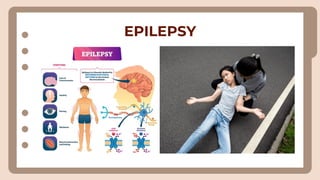 EPILEPSY
 