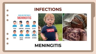 INFECTIONS
MENINGITIS
 