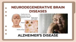 NEURODEGENERATIVE BRAIN
DISEASES
ALZHEIMER’S DISEASE
 