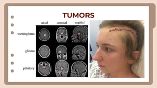 TUMORS
 