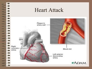 Heart Attack
 