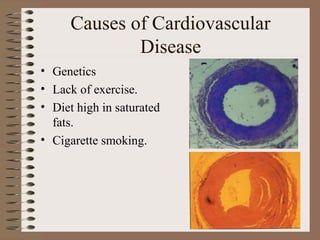 Causes of Cardiovascular
              Disease
• Genetics
• Lack of exercise.
• Diet high in saturated
  fats.
• Cigarette smoking.
 