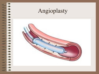 Angioplasty
 