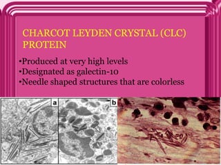 CHARCOT LEYDEN CRYSTAL (CLC)
PROTEIN
•Produced at very high levels
•Designated as galectin-10
•Needle shaped structures that are colorless
 