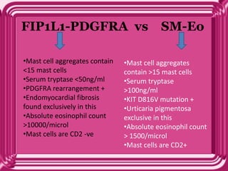 FIP1L1-PDGFRA vs SM-Eo
•Mast cell aggregates contain
<15 mast cells
•Serum tryptase <50ng/ml
•PDGFRA rearrangement +
•Endomyocardial fibrosis
found exclusively in this
•Absolute eosinophil count
>10000/microl
•Mast cells are CD2 -ve
•Mast cell aggregates
contain >15 mast cells
•Serum tryptase
>100ng/ml
•KIT D816V mutation +
•Urticaria pigmentosa
exclusive in this
•Absolute eosinophil count
> 1500/microl
•Mast cells are CD2+
 