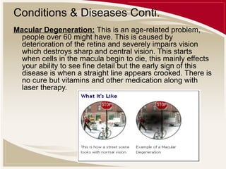 Conditions & Diseases Conti.
Macular Degeneration: This is an age-related problem,
people over 60 might have. This is caused by
deterioration of the retina and severely impairs vision
which destroys sharp and central vision. This starts
when cells in the macula begin to die, this mainly effects
your ability to see fine detail but the early sign of this
disease is when a straight line appears crooked. There is
no cure but vitamins and other medication along with
laser therapy.

 