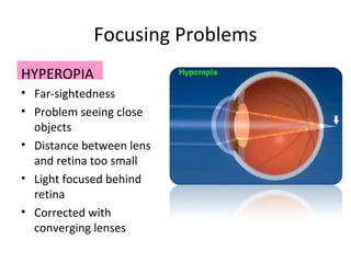 Focusing Problems
HYPEROPIA
• Far-sightedness
• Problem seeing close
objects
• Distance between lens
and retina too small
• Light focused behind
retina
• Corrected with
converging lenses
 
