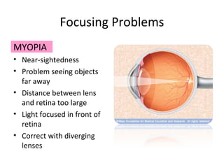 Focusing Problems
MYOPIA
• Near-sightedness
• Problem seeing objects
far away
• Distance between lens
and retina too large
• Light focused in front of
retina
• Correct with diverging
lenses
 