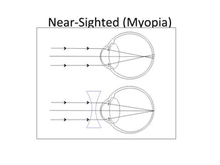 Near-Sighted (Myopia)
 