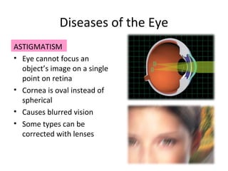 Diseases of the Eye
ASTIGMATISM
• Eye cannot focus an
object’s image on a single
point on retina
• Cornea is oval instead of
spherical
• Causes blurred vision
• Some types can be
corrected with lenses
 