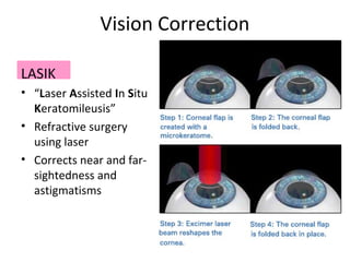 Vision Correction
LASIK
• “Laser Assisted In Situ
Keratomileusis”
• Refractive surgery
using laser
• Corrects near and far-
sightedness and
astigmatisms
 