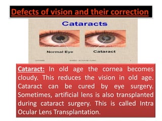 Cataract: In old age the cornea becomes
cloudy. This reduces the vision in old age.
Cataract can be cured by eye surgery.
Sometimes, artificial lens is also transplanted
during cataract surgery. This is called Intra
Ocular Lens Transplantation.
Defects of vision and their correction
 