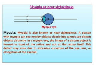 Myopia or near sightedness
Myopia: Myopia is also known as near-sightedness. A person
with myopia can see nearby objects clearly but cannot see distant
objects distinctly. In a myopic eye, the image of a distant object is
formed in front of the retina and not at the retina itself. This
defect may arise due to excessive curvature of the eye lens, or
elongation of the eyeball.
Myopic eye
 
