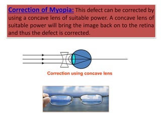 Correction using concave lens
Correction of Myopia: This defect can be corrected by
using a concave lens of suitable power. A concave lens of
suitable power will bring the image back on to the retina
and thus the defect is corrected.
 