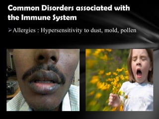 Allergies : Hypersensitivity to dust, mold, pollen
Common Disorders associated with
the Immune System
 