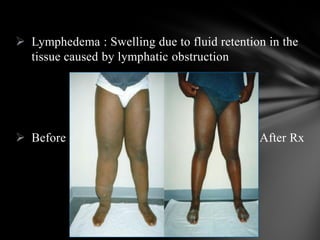  Lymphedema : Swelling due to fluid retention in the
tissue caused by lymphatic obstruction
 Before After Rx
 