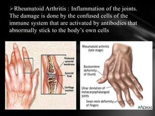 Rheumatoid Arthritis : Inflammation of the joints.
The damage is done by the confused cells of the
immune system that are activated by antibodies that
abnormally stick to the body’s own cells
 