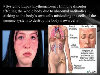 Systemic Lupus Erythematosus : Immune disorder
affecting the whole body due to abnormal antibodies
sticking to the body’s own cells misleading the cells of the
immune system to destroy the body’s own cells
 