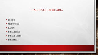 CAUSES OF URTICARIA
• FOODS
• MEDICINES
• LATEX
• INFECTIONS
• INSECT BITES
• DISEASES
 