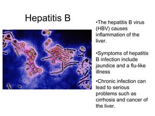 Hepatitis B •The hepatitis B virus
(HBV) causes
inflammation of the
liver.
•Symptoms of hepatitis
B infection include
jaundice and a flu-like
illness
•Chronic infection can
lead to serious
problems such as
cirrhosis and cancer of
the liver.
 