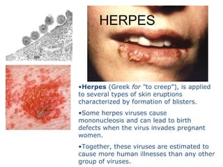 •Herpes (Greek for “to creep”), is applied 
to several types of skin eruptions 
characterized by formation of blisters.
•Some herpes viruses cause   
mononucleosis and can lead to birth 
defects when the virus invades pregnant 
women. 
•Together, these viruses are estimated to 
cause more human illnesses than any other 
group of viruses.
HERPES
 