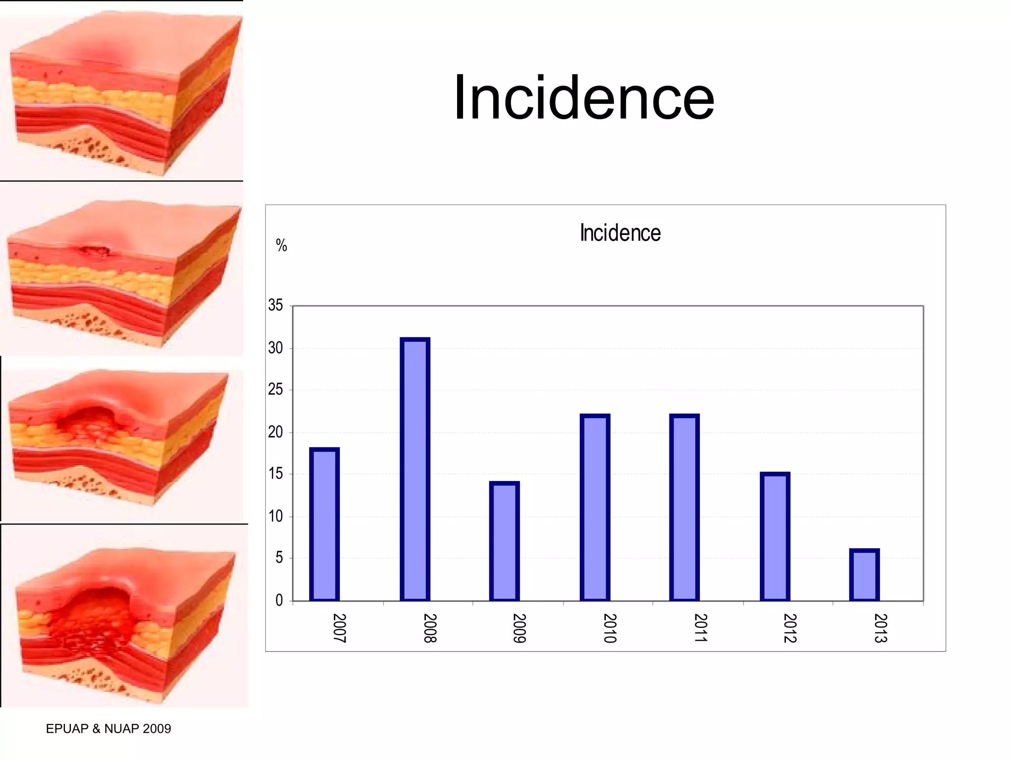 Incidence 
EPUAP & NUAP 2009 
Incidence 
35 
30 
25 
20 
15 
10 
5 
0 
2007 
2008 
2009 
2010 
2011 
2012 
2013 
% 
 
