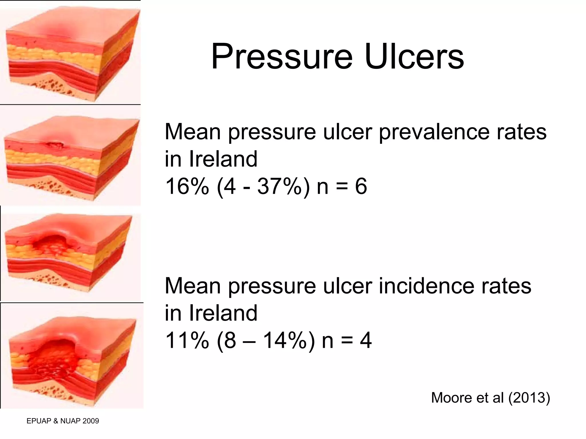 Pressure Ulcers 
EPUAP & NUAP 2009 
Mean pressure ulcer prevalence rates 
in Ireland 
16% (4 - 37%) n = 6 
Mean pressure ulcer incidence rates 
in Ireland 
11% (8 – 14%) n = 4 
Moore et al (2013) 
 