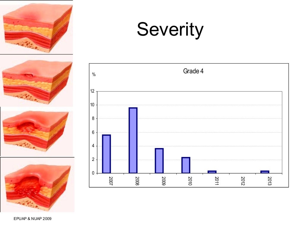 The Impact of a CNS in Tissue Viability on Pressure Ulcer Reduction i…