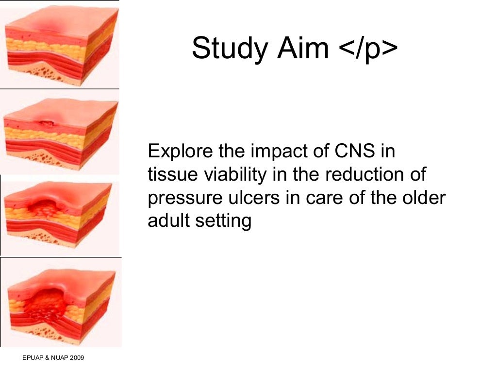 The Impact of a CNS in Tissue Viability on Pressure Ulcer Reduction i…