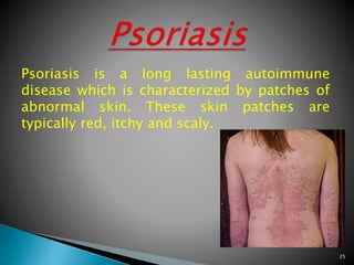 Psoriasis is a long lasting autoimmune
disease which is characterized by patches of
abnormal skin. These skin patches are
typically red, itchy and scaly.
25
 
