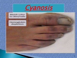 27
Cyanosis
 