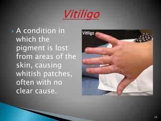  A condition in
which the
pigment is lost
from areas of the
skin, causing
whitish patches,
often with no
clear cause.
29
 