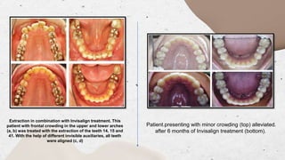 THE INVISALIGN aligner in orthodontics .pptx