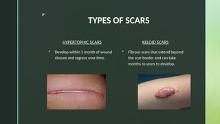 How Do Scars Develop THE JOURNEY TO A DESIRABLE SCAR FOR HEALTHCARE PROVIDERS.pptx