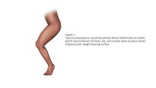 Figure 1
Typical jump posture caused by plantar flexion deformities of ankles,
which require flexion of knees, hip, and lumbar spine to place center
of gravity over weight bearing surface.
 