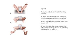 Figure 3
Testing for adductor and medial hamstring
tightness
A, Thighs abduct well with hips and knees
flexed, indicating no adductor contracture
B, With hips extended and knees flexed, hips
abduct well
C, With hips extended, bringing knees into
extension causes thighs to adduct, indicating
medial hamstring spasticity.
 