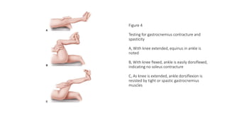 Figure 4
Testing for gastrocnemius contracture and
spasticity
A, With knee extended, equinus in ankle is
noted
B, With knee flexed, ankle is easily dorsiflexed,
indicating no soleus contracture
C, As knee is extended, ankle dorsiflexion is
resisted by tight or spastic gastrocnemius
muscles
 