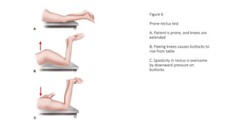 Figure 6
Prone rectus test
A, Patient is prone, and knees are
extended
B, Flexing knees causes buttocks to
rise from table
C, Spasticity in rectus is overcome
by downward pressure on
buttocks.
 