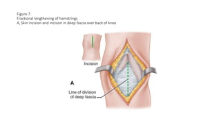 Figure 7
Fractional lengthening of hamstrings
A, Skin incision and incision in deep fascia over back of knee
 