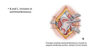 • B and C, Incisions in
semimembranosus
 