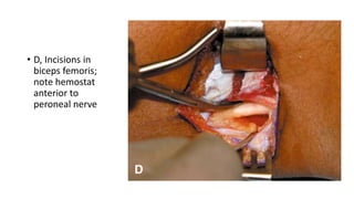 • D, Incisions in
biceps femoris;
note hemostat
anterior to
peroneal nerve
 