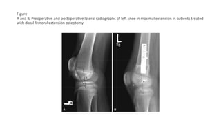 Figure
A and B, Preoperative and postoperative lateral radiographs of left knee in maximal extension in patients treated
with distal femoral extension osteotomy
 