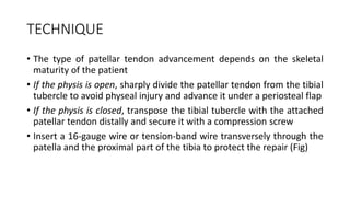 TECHNIQUE
• The type of patellar tendon advancement depends on the skeletal
maturity of the patient
• If the physis is open, sharply divide the patellar tendon from the tibial
tubercle to avoid physeal injury and advance it under a periosteal flap
• If the physis is closed, transpose the tibial tubercle with the attached
patellar tendon distally and secure it with a compression screw
• Insert a 16-gauge wire or tension-band wire transversely through the
patella and the proximal part of the tibia to protect the repair (Fig)
 